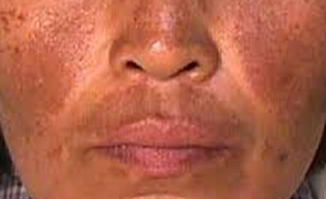 Melasma most notably appears on the forehead, upper lip, nose and cheeks.