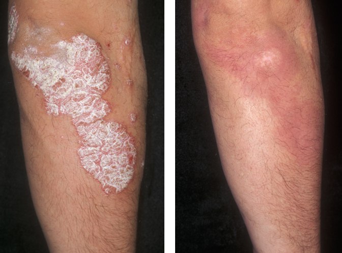 Psoriasis before and after treatment