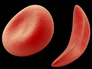 “Sickle” red blood cells are curved like the farm tool of the same name.