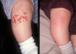Red birthmarks before and after treatment 