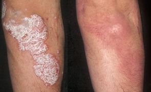 Psoriasis before and after treatment
