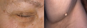  Skin tag on eyelid (l) and on arm