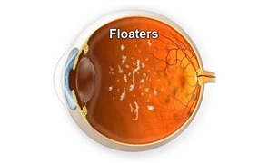 advice.eye-floaters.web