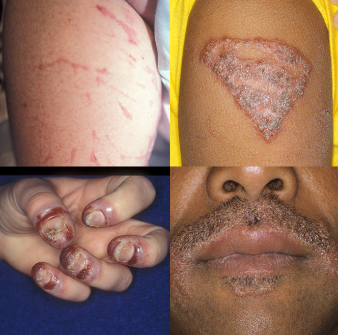 Allergic contact dermatitis due to (clockwise from top left) poison ivy on the leg, temporary tattoo dye, dye for beards and moustaches, and acrylic nail glue