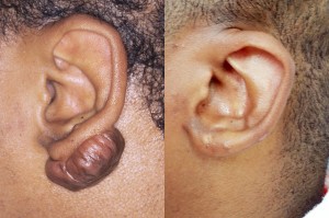 Keloids before (l) and after