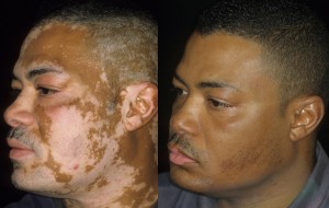 Vitiligo before (l) and after
